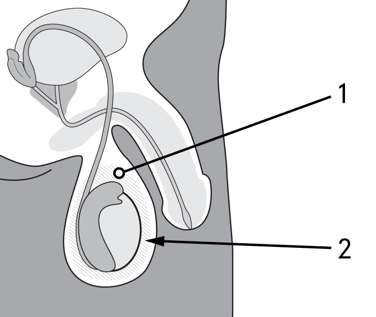 Illustration shows a location of haematoma and swollen testes