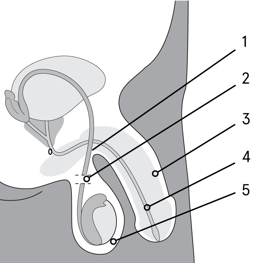 Diagram of vasectomy and surrounding area