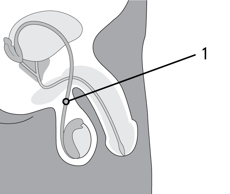 Diagram showing location of vasectomy failure due to regrowth of vas deferens