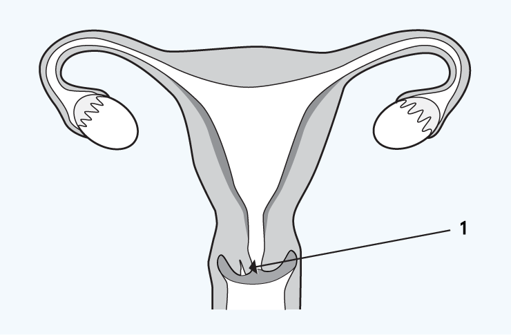 Damage or tearing of the cervix