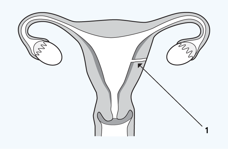 Perforation of the uterus