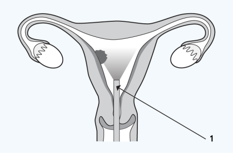 Clinical Services Information - Surgical abortion | MSI Australia