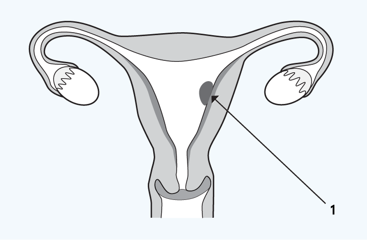 Retained clot or pregnancy illustration